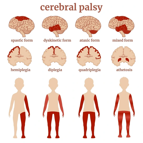 Types of Cerebral Palsy